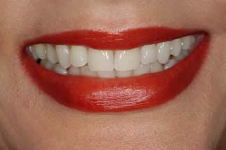 bleaching london after