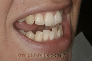 inman aligner before london