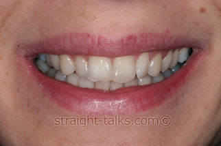 inman aligner before london