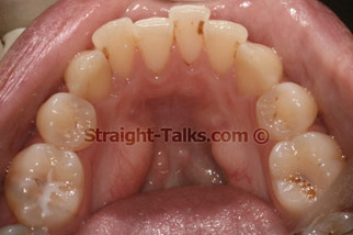 inman aligner before london