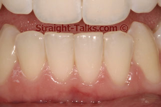 inman aligner after london