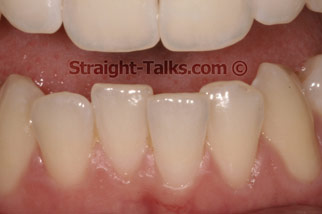 inman aligner before london