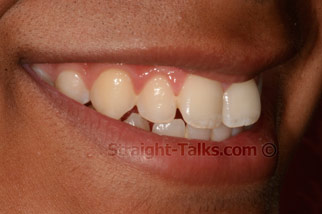 inman aligner before london