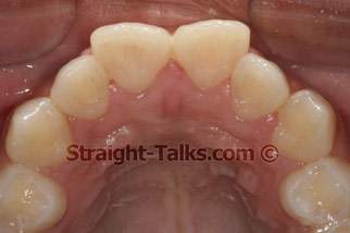inman aligner before london