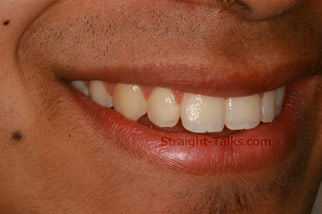 inman aligner after london