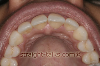 inman aligner after london