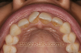 inman aligner before london