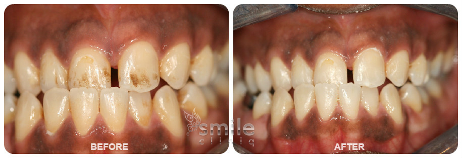Dental Hygiene Before and After Treatment