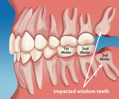 wisdom-tooth-extraction-london
