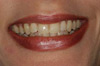 tooth whitening london before