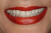 tooth whitening london after