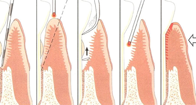 Laser Assisted Periodontal Gum Treatment Step by Step