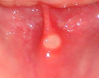 Mouth Ulcer