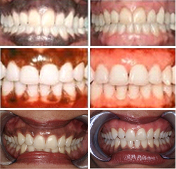 Laser Gum Bleaching Before's and After's 