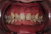 veneers london before