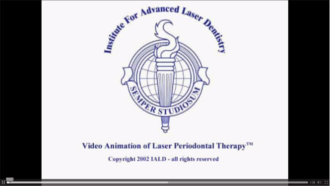 Laser-Assisted Periodontal Treatment Video