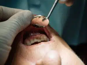 10 tips to avoid getting tooth decay