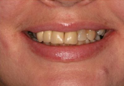 Before Dental Crowns Treatment