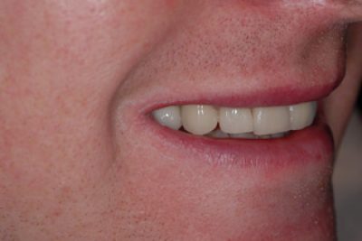 veneers_london_after