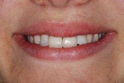 Dental Crown London Treatment After