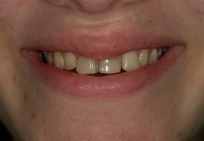 Dental Crown London Treatment Before