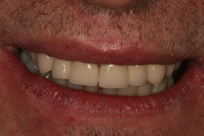 Dental Crown in London Treatment After