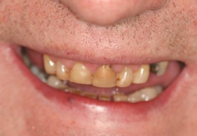Dental Crown in London Treatment Before