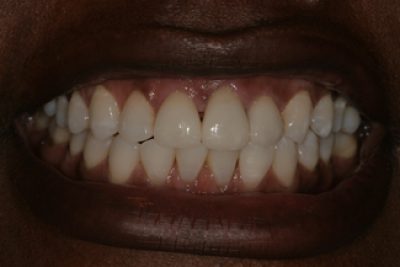 Treatment for Dental Crowns in London After