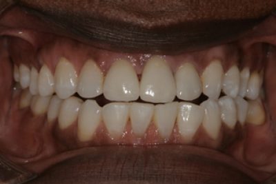 Treatment for Dental Crowns After