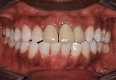 Treatment for Dental Crowns Before