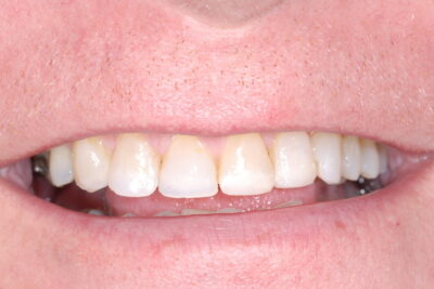 Composite Veneers London After