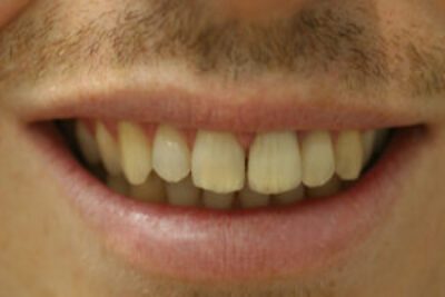 veneers_london_after