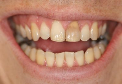 veneers_london_before
