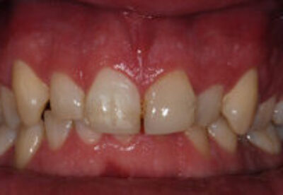 veneers_london_before