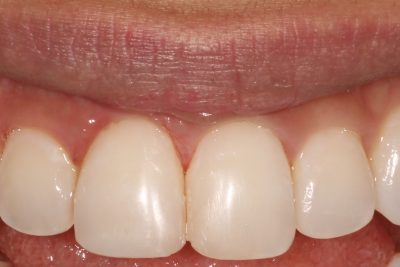 Composite Veneers Dentist London