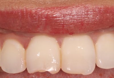 Composite Veneers Dentist London