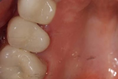 Dental Crowns London After