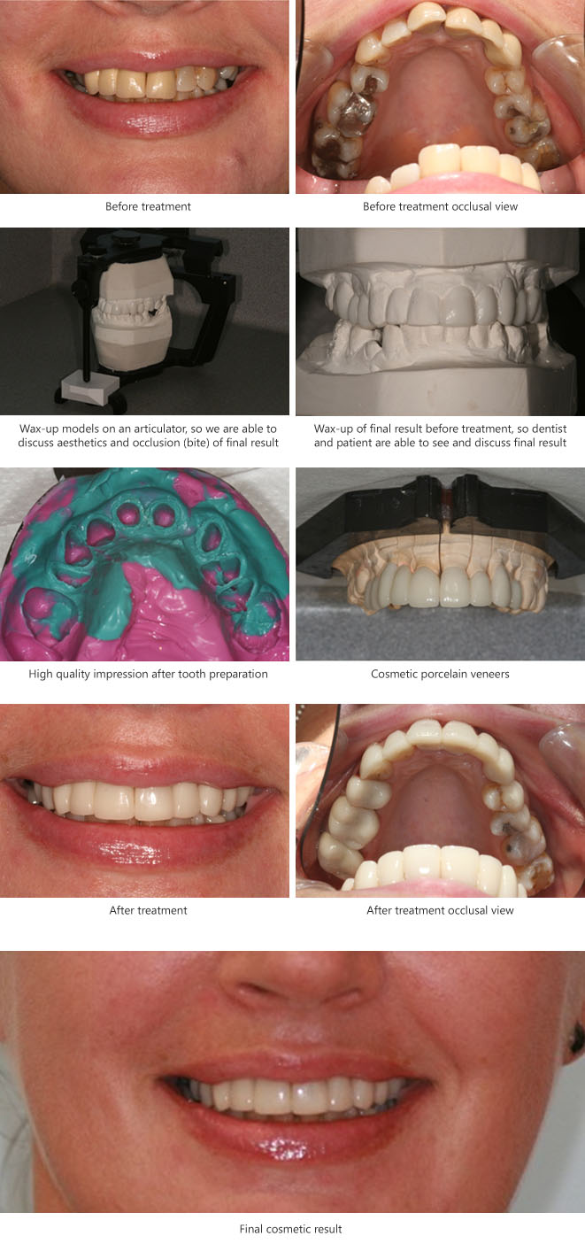 Pre restorative orthodontic alignment Before and After