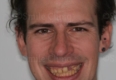 London Dentist Smile Makeover Before