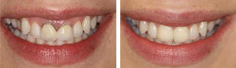 Dental Crowns Before and After