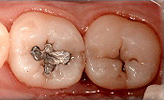 White Tooth Fillings Composite Bonding Before