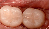 White Tooth Fillings Composite Bonding After