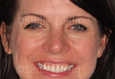 London Dentist Veneers Before