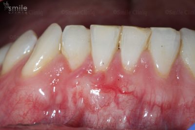 After gum graft