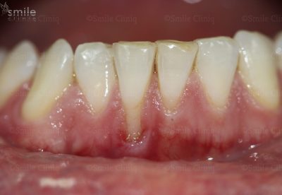 Before gum graft