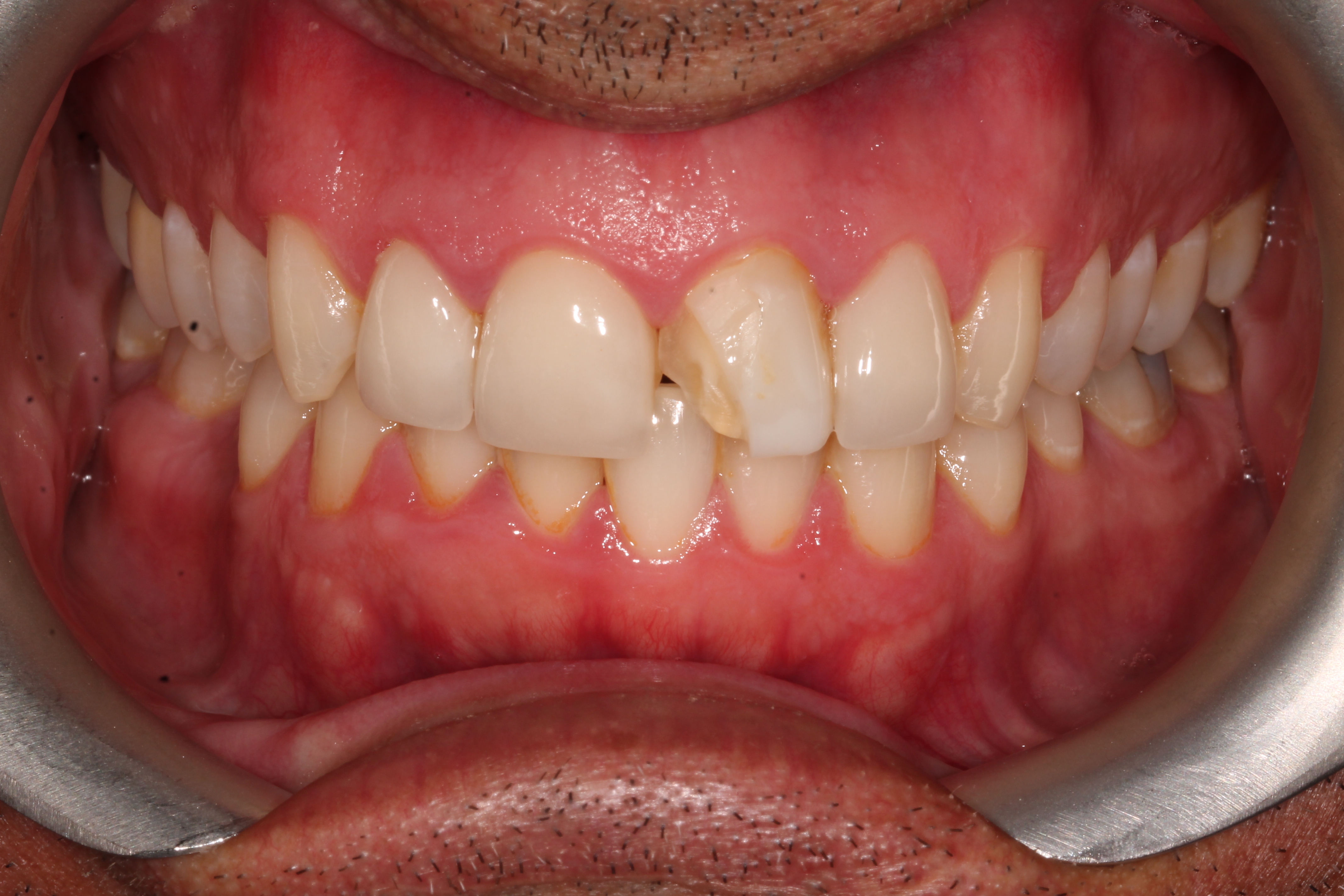 Affordable Cosmetic Dental Veneers by Award Winning Dentists