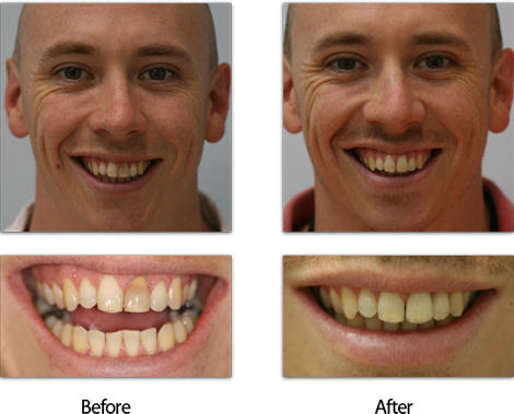 Dark Tooth London Treatment Before and After