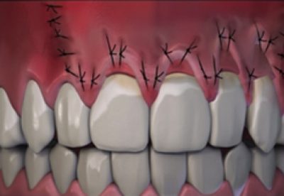 Receding Gum Treatment Graphic Before