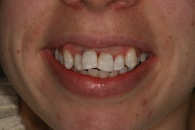 Dark Teeth Treatment After