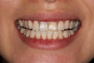 nothing but blackened teeth reviews nothing but blackened teeth reviews